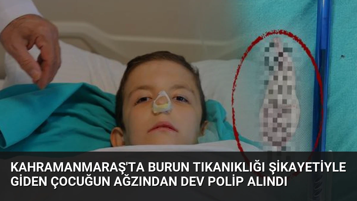 Kahramanmaraş’ta Burun Tıkanıklığı Şikayetiyle Giden Çocuğun Ağzından Dev Polip Alındı